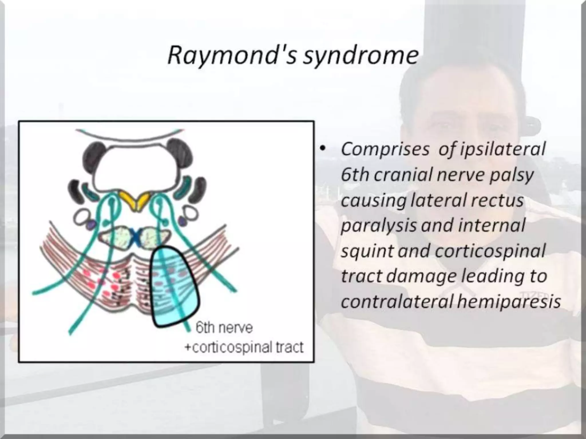 Localization of brainstem lesion by Prof Dr Bashir Ahmed Dar Sopore Kashmir