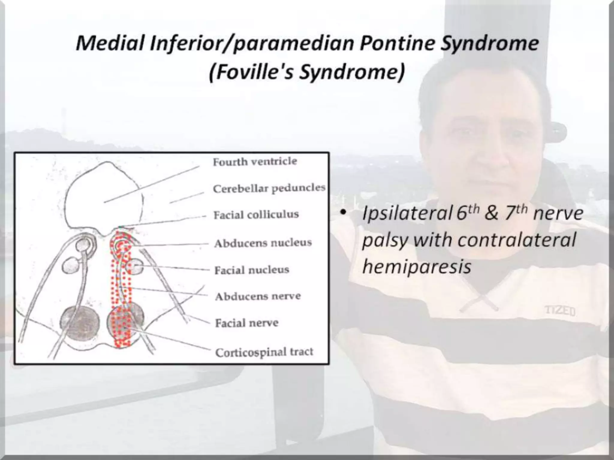Localization of brainstem lesion by Prof Dr Bashir Ahmed Dar Sopore Kashmir