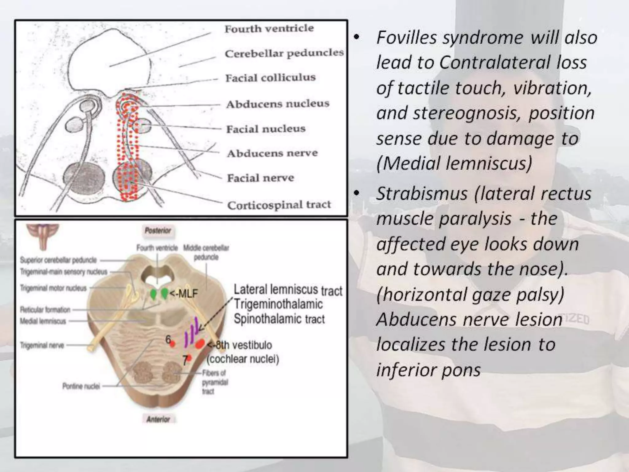 Localization of brainstem lesion by Prof Dr Bashir Ahmed Dar Sopore Kashmir