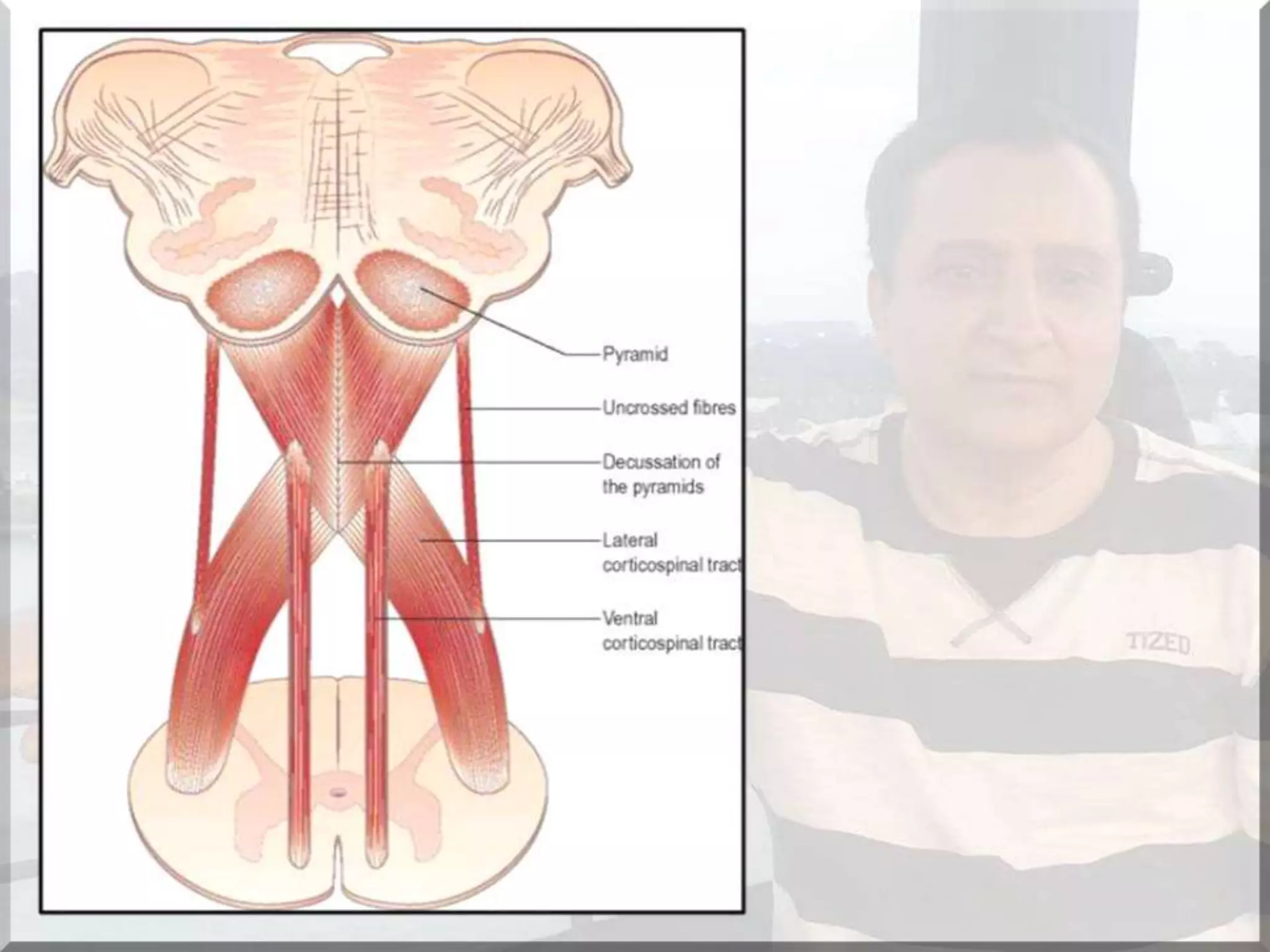 Localization of brainstem lesion by Prof Dr Bashir Ahmed Dar Sopore Kashmir