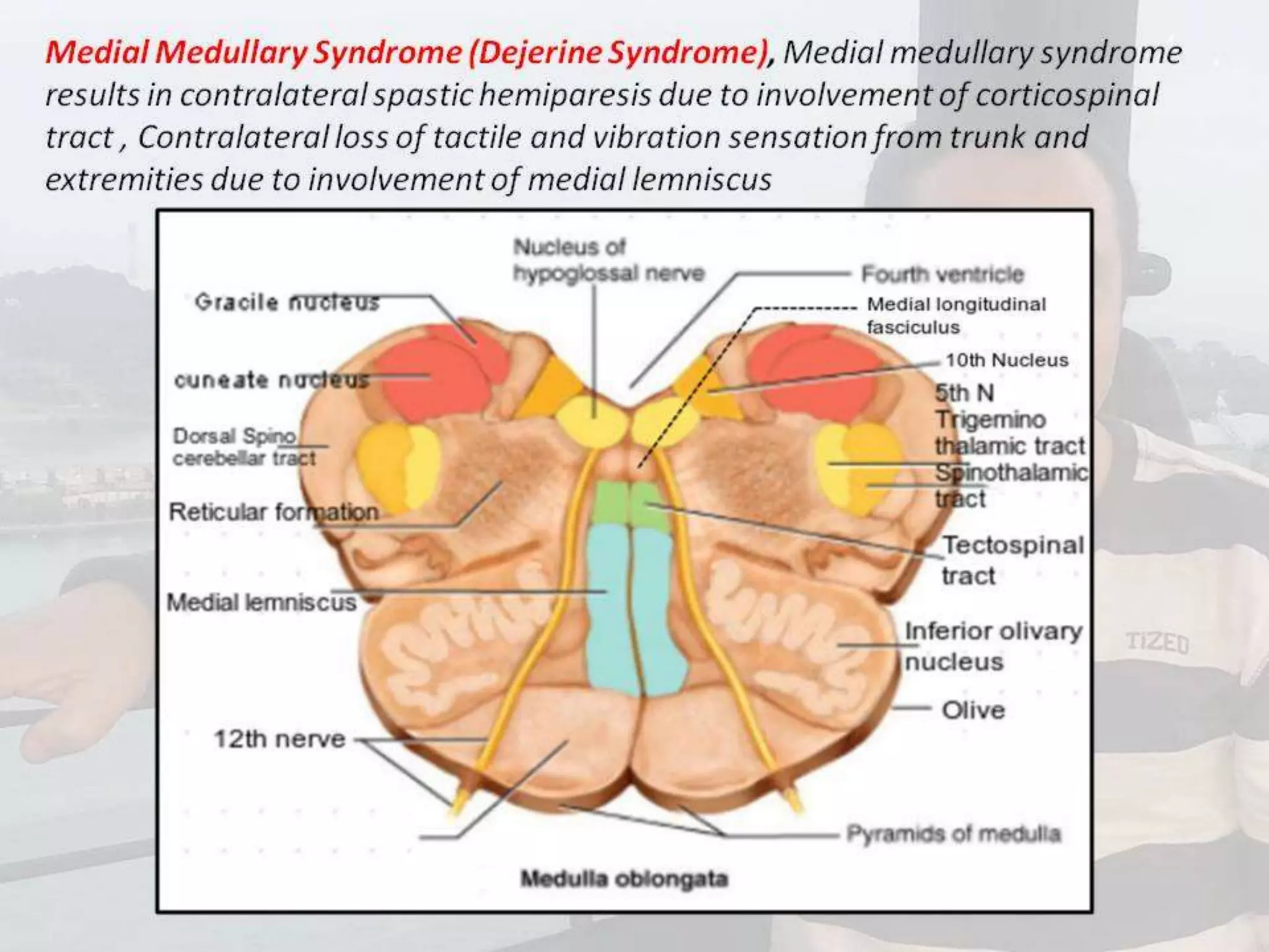 Localization of brainstem lesion by Prof Dr Bashir Ahmed Dar Sopore Kashmir