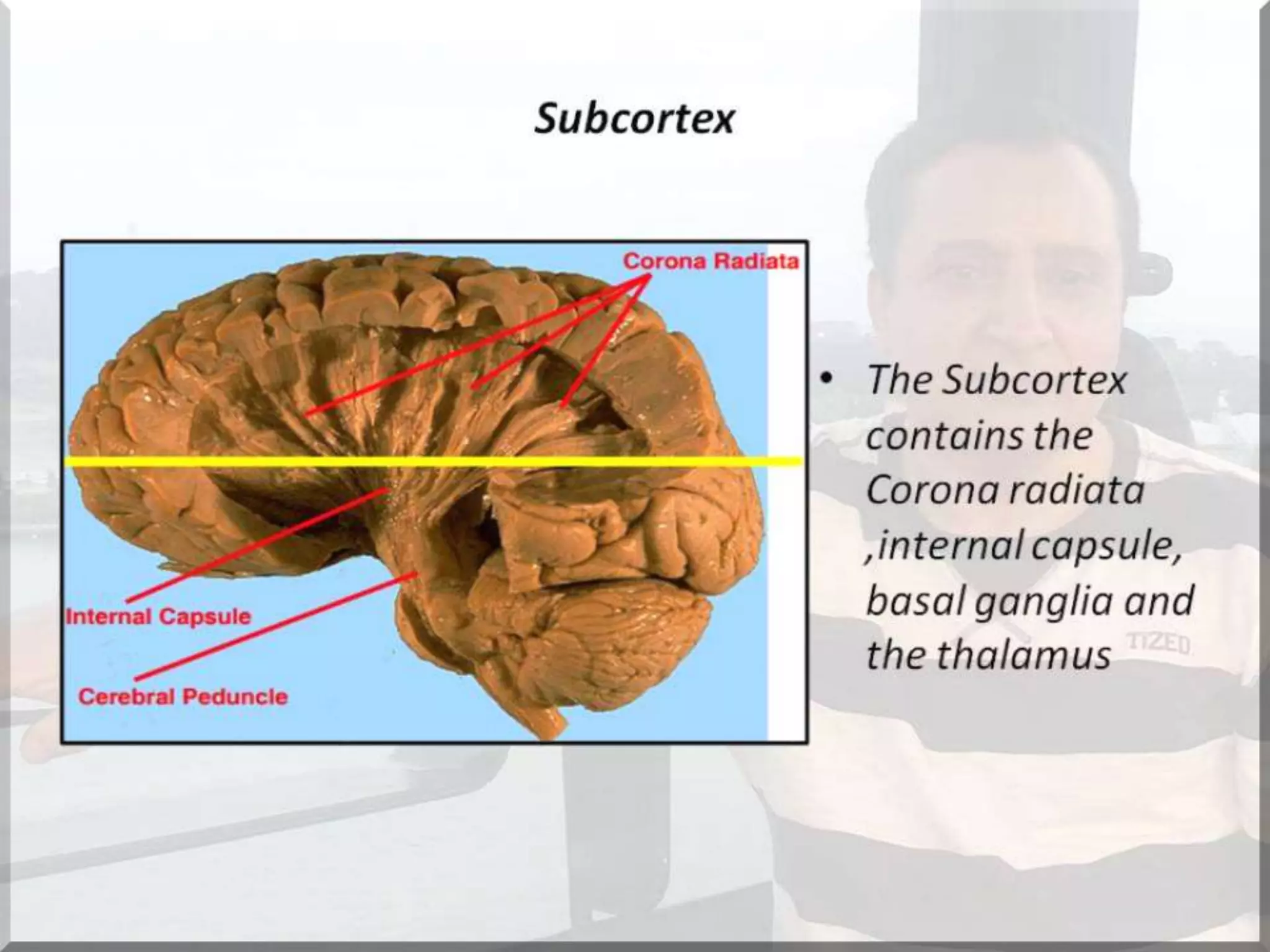 Localization of brainstem lesion by Prof Dr Bashir Ahmed Dar Sopore Kashmir