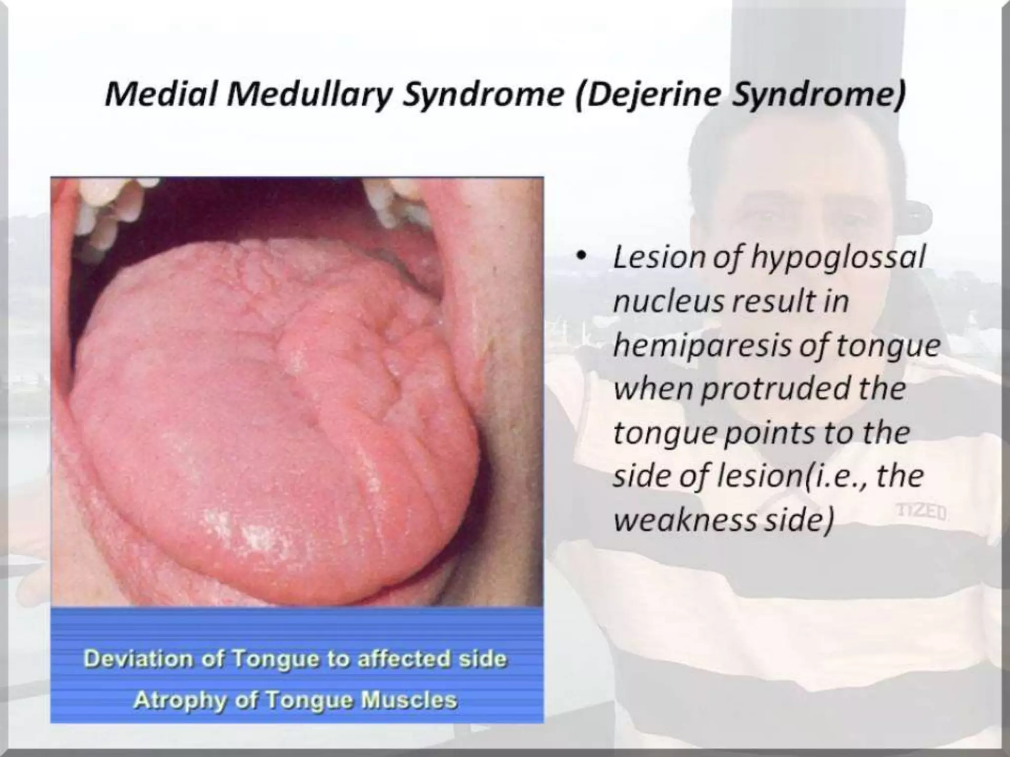 Localization of brainstem lesion by Prof Dr Bashir Ahmed Dar Sopore Kashmir