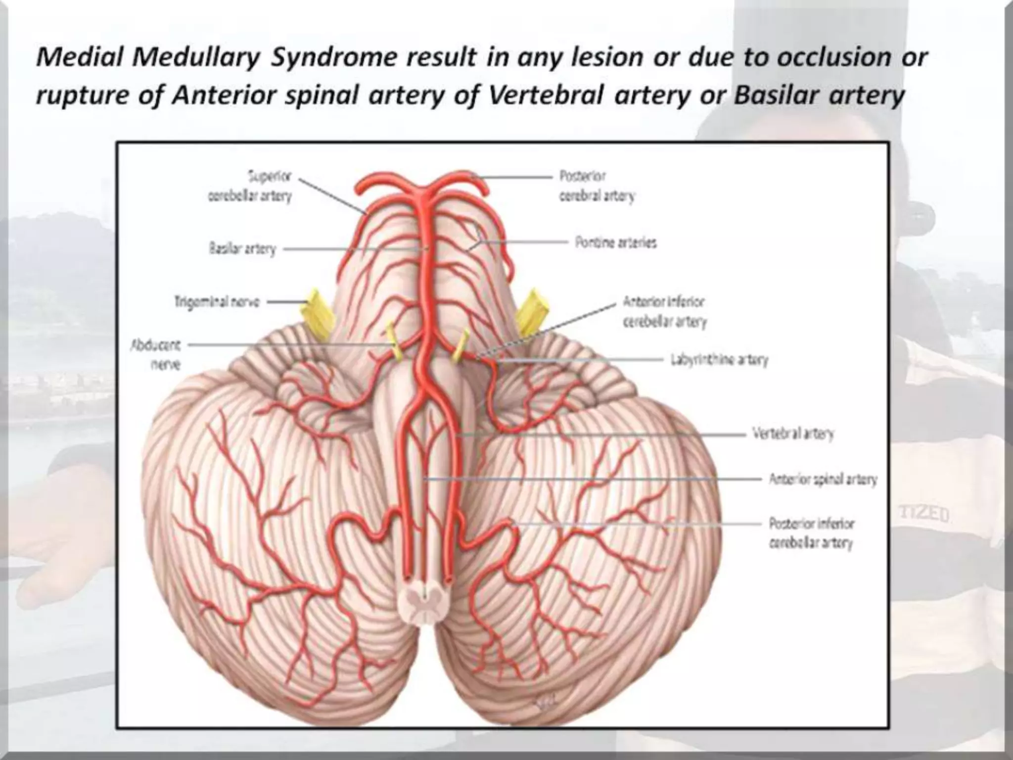 Localization of brainstem lesion by Prof Dr Bashir Ahmed Dar Sopore Kashmir
