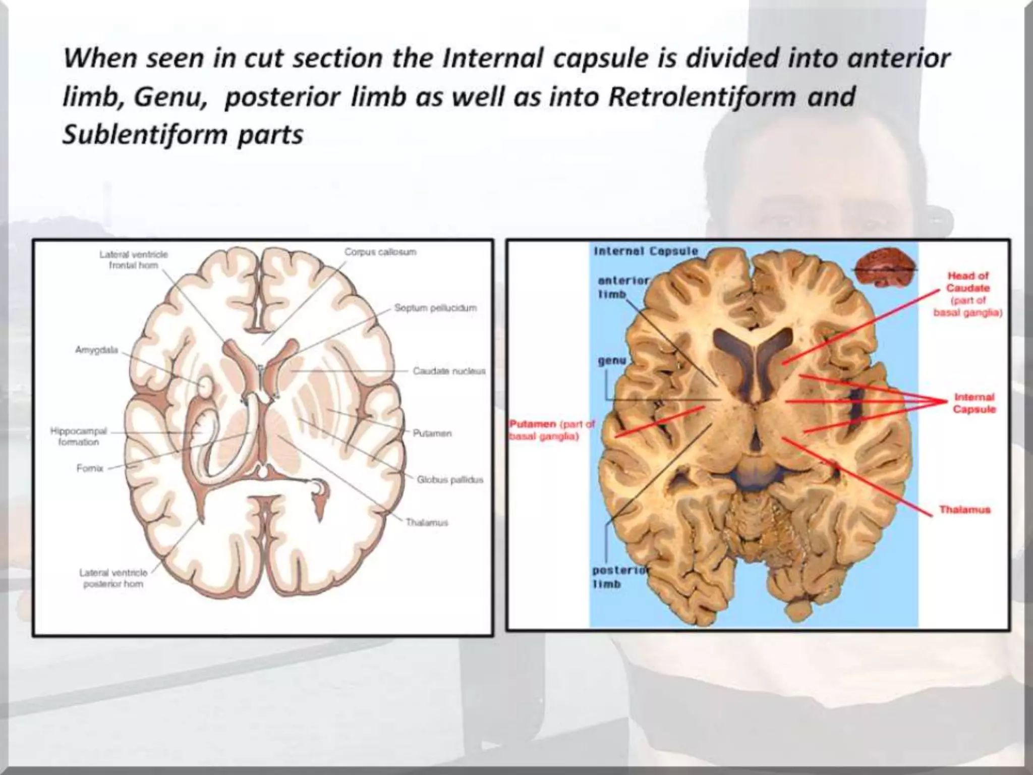 Localization of brainstem lesion by Prof Dr Bashir Ahmed Dar Sopore Kashmir