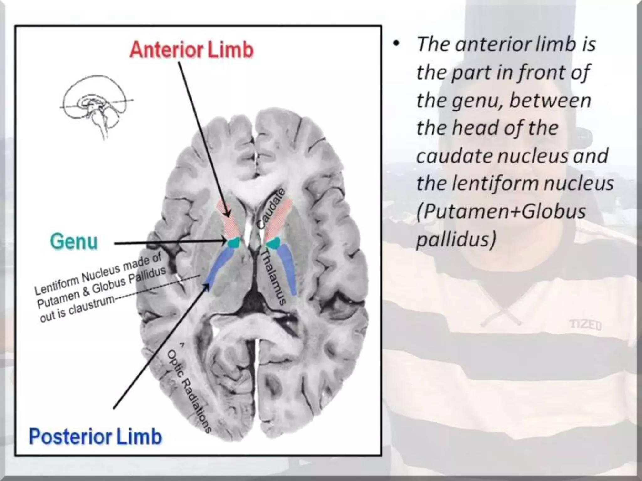 Localization of brainstem lesion by Prof Dr Bashir Ahmed Dar Sopore Kashmir