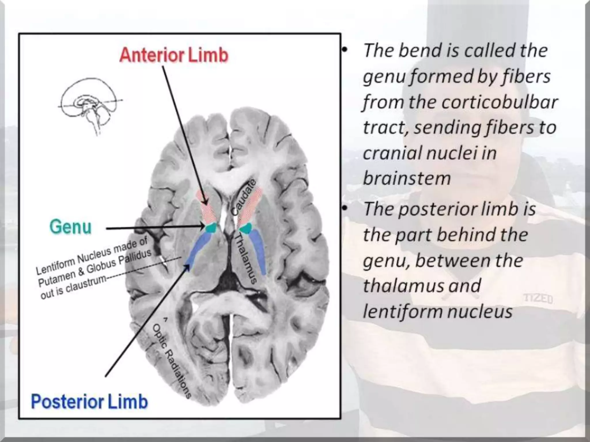 Localization of brainstem lesion by Prof Dr Bashir Ahmed Dar Sopore Kashmir