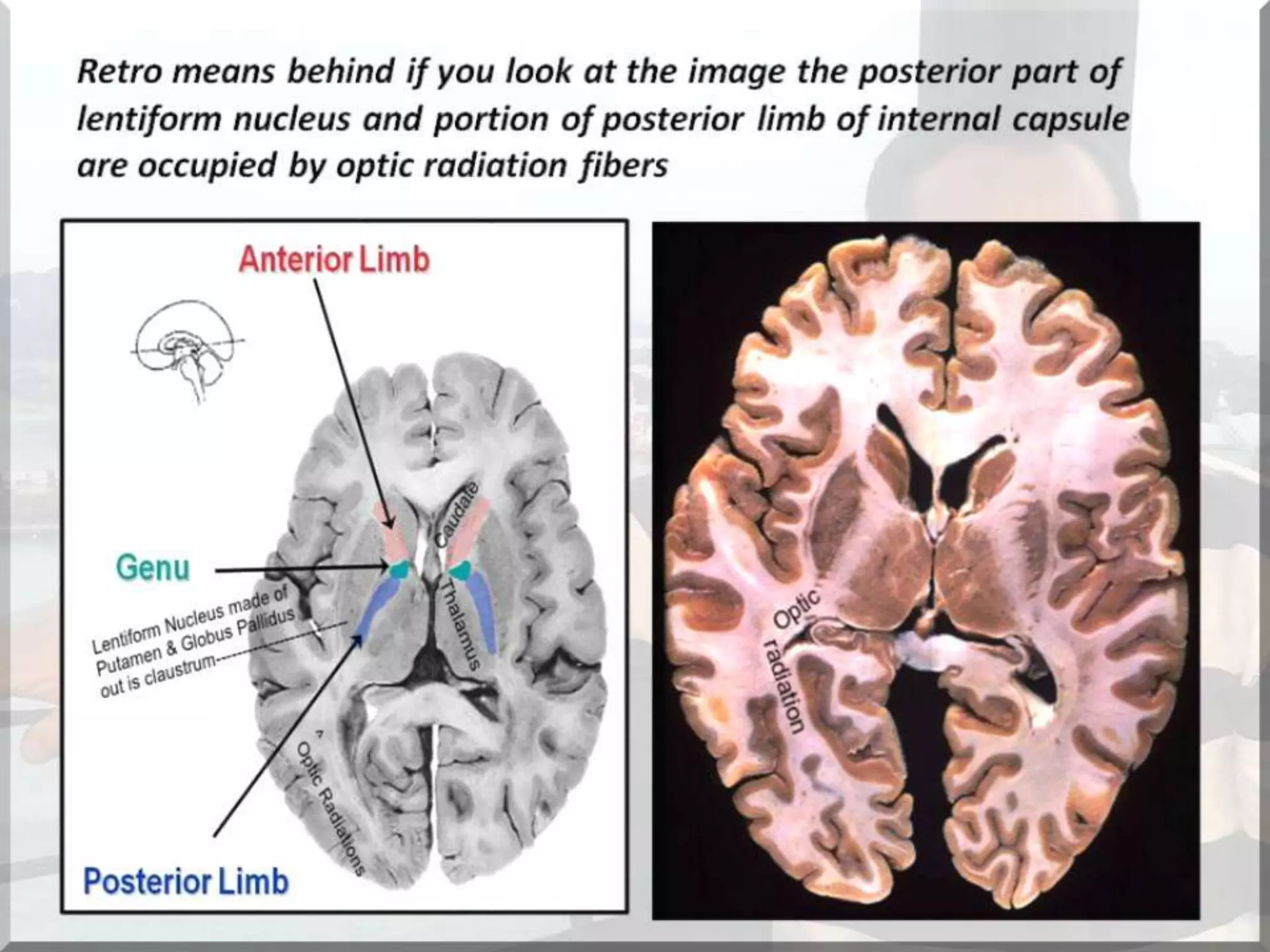 Localization of brainstem lesion by Prof Dr Bashir Ahmed Dar Sopore Kashmir