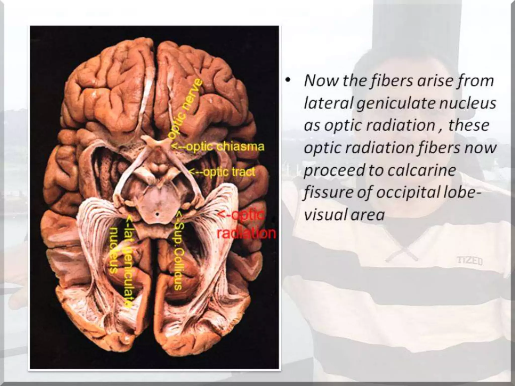 Localization of brainstem lesion by Prof Dr Bashir Ahmed Dar Sopore Kashmir