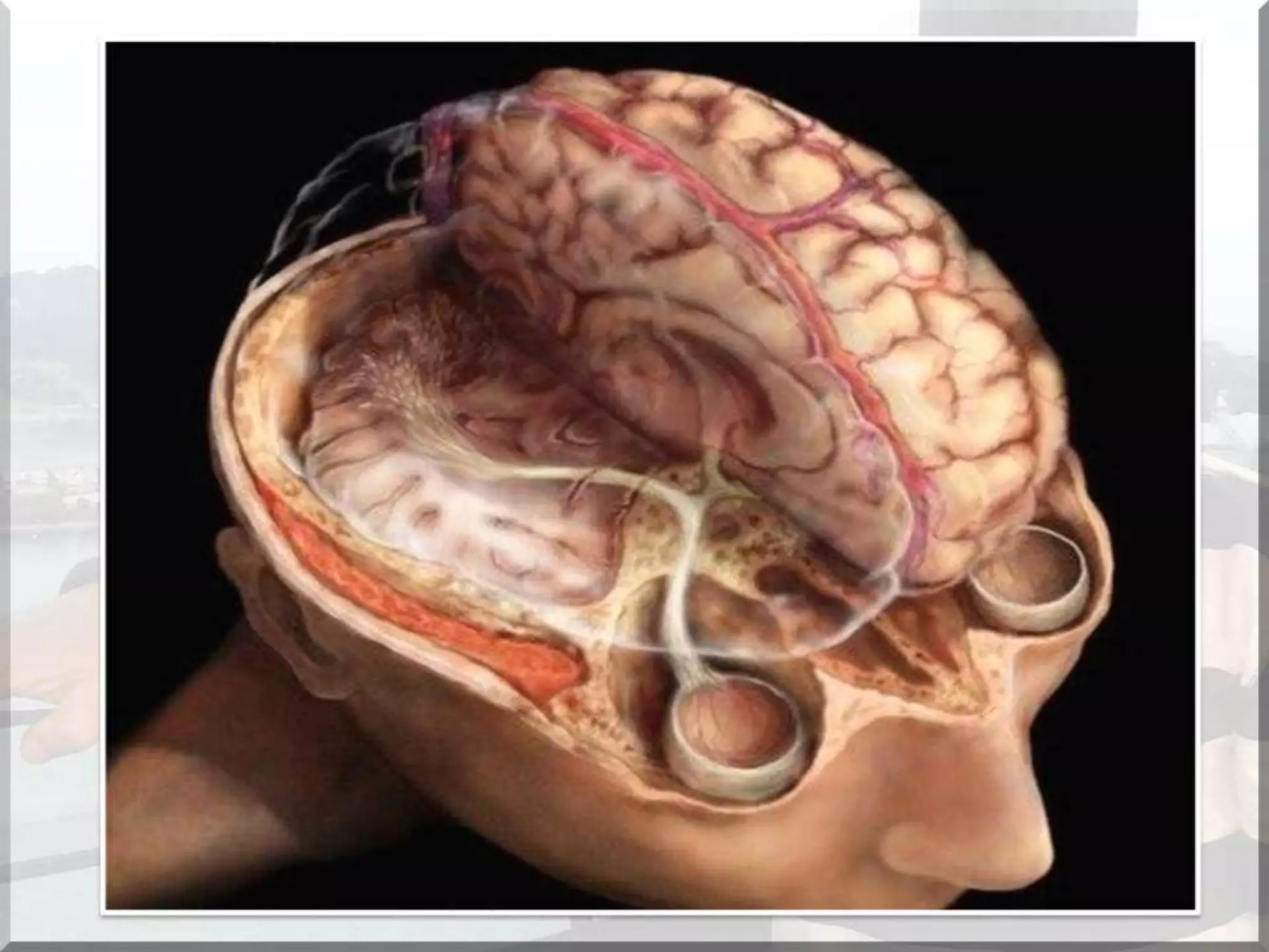 Localization of brainstem lesion by Prof Dr Bashir Ahmed Dar Sopore Kashmir