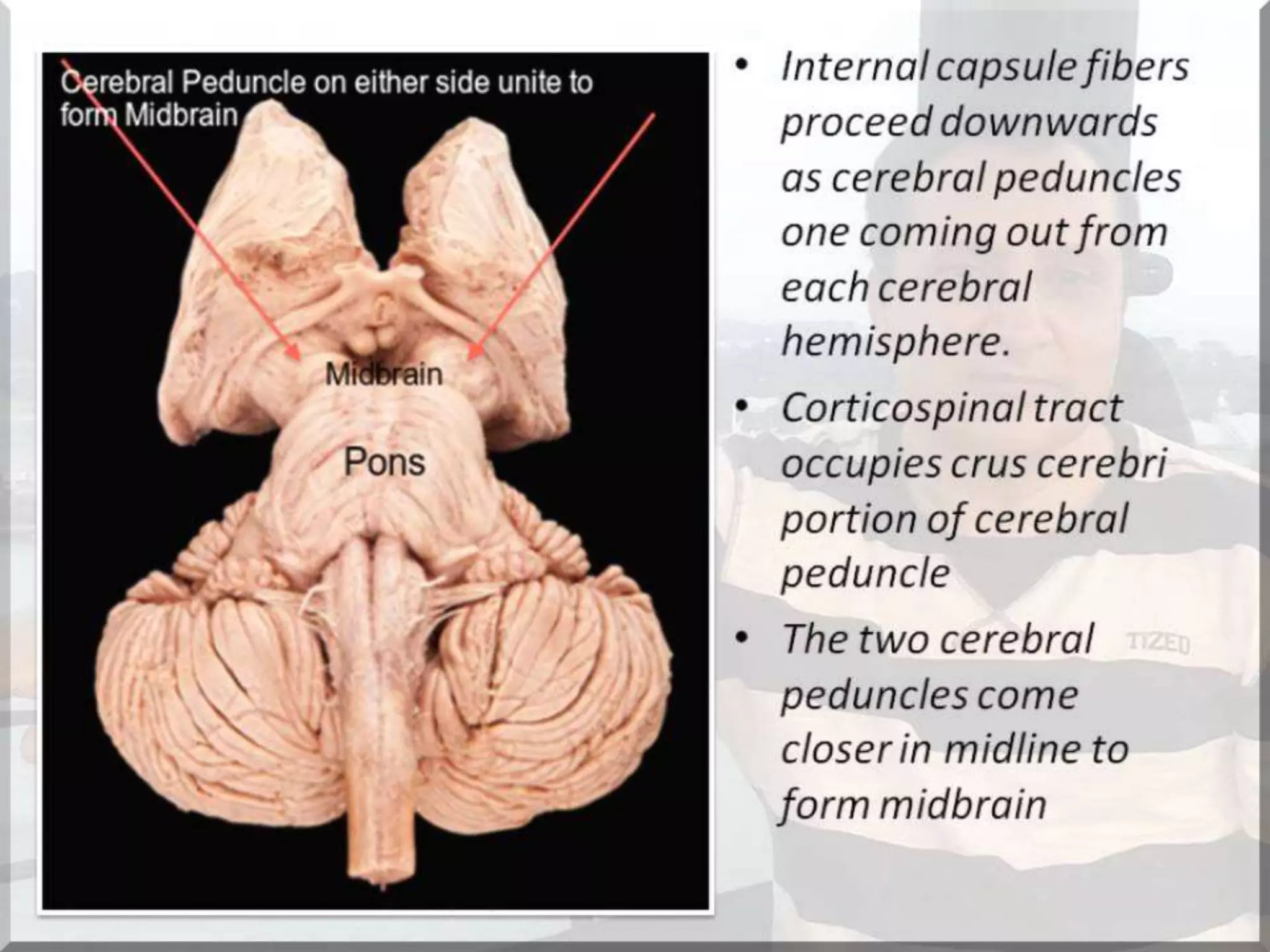 Localization of brainstem lesion by Prof Dr Bashir Ahmed Dar Sopore Kashmir