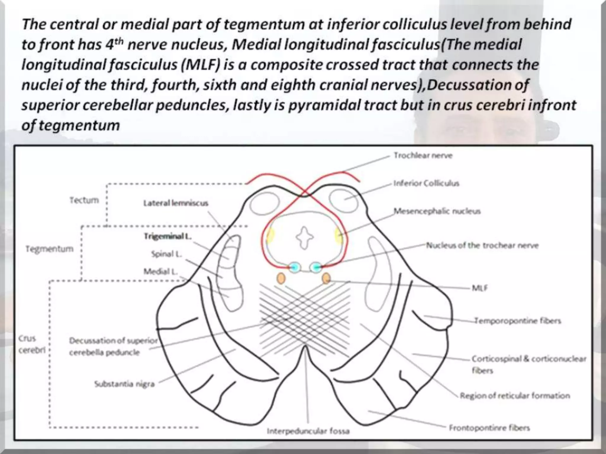 Localization of brainstem lesion by Prof Dr Bashir Ahmed Dar Sopore Kashmir