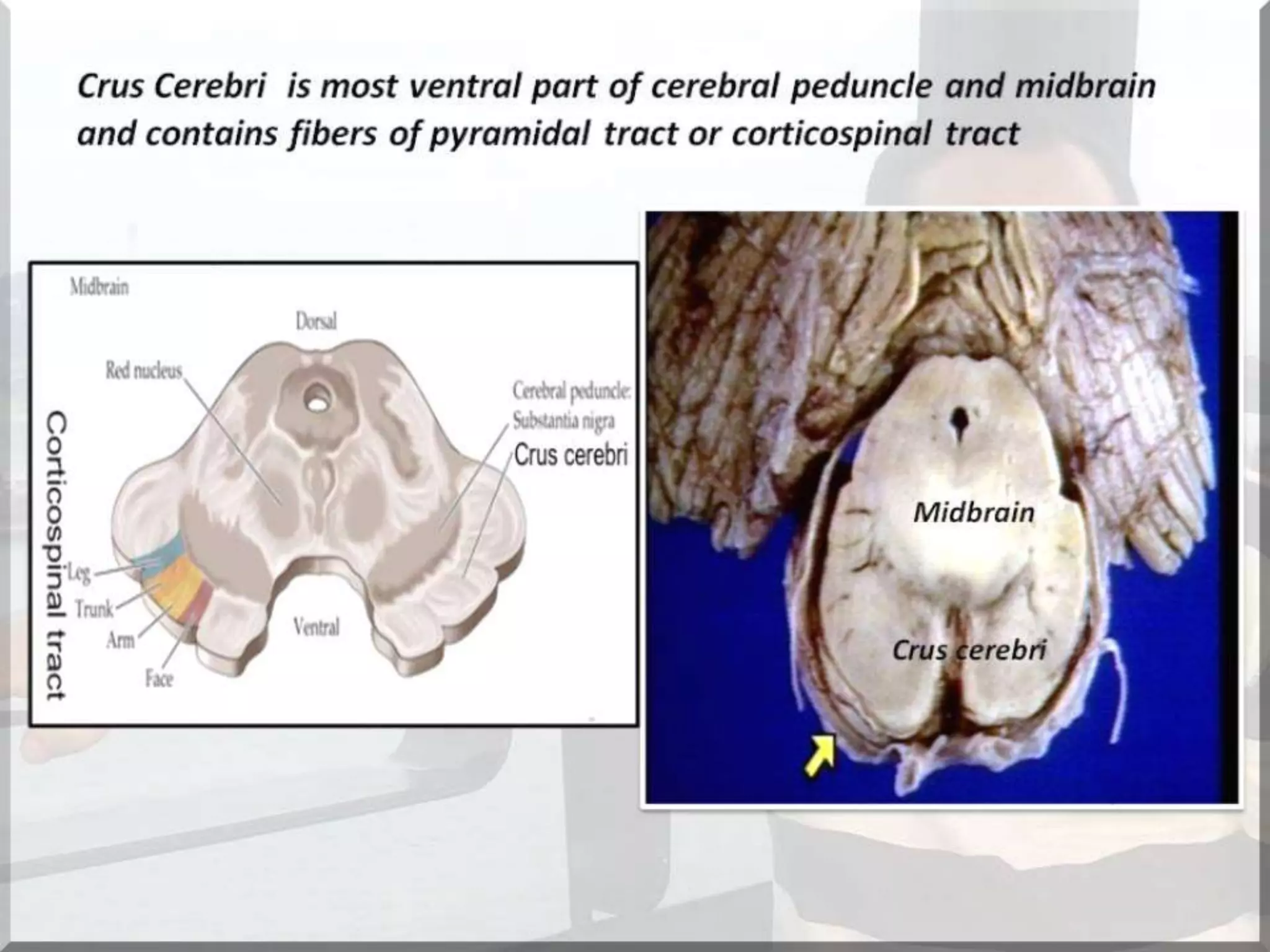 Localization of brainstem lesion by Prof Dr Bashir Ahmed Dar Sopore Kashmir