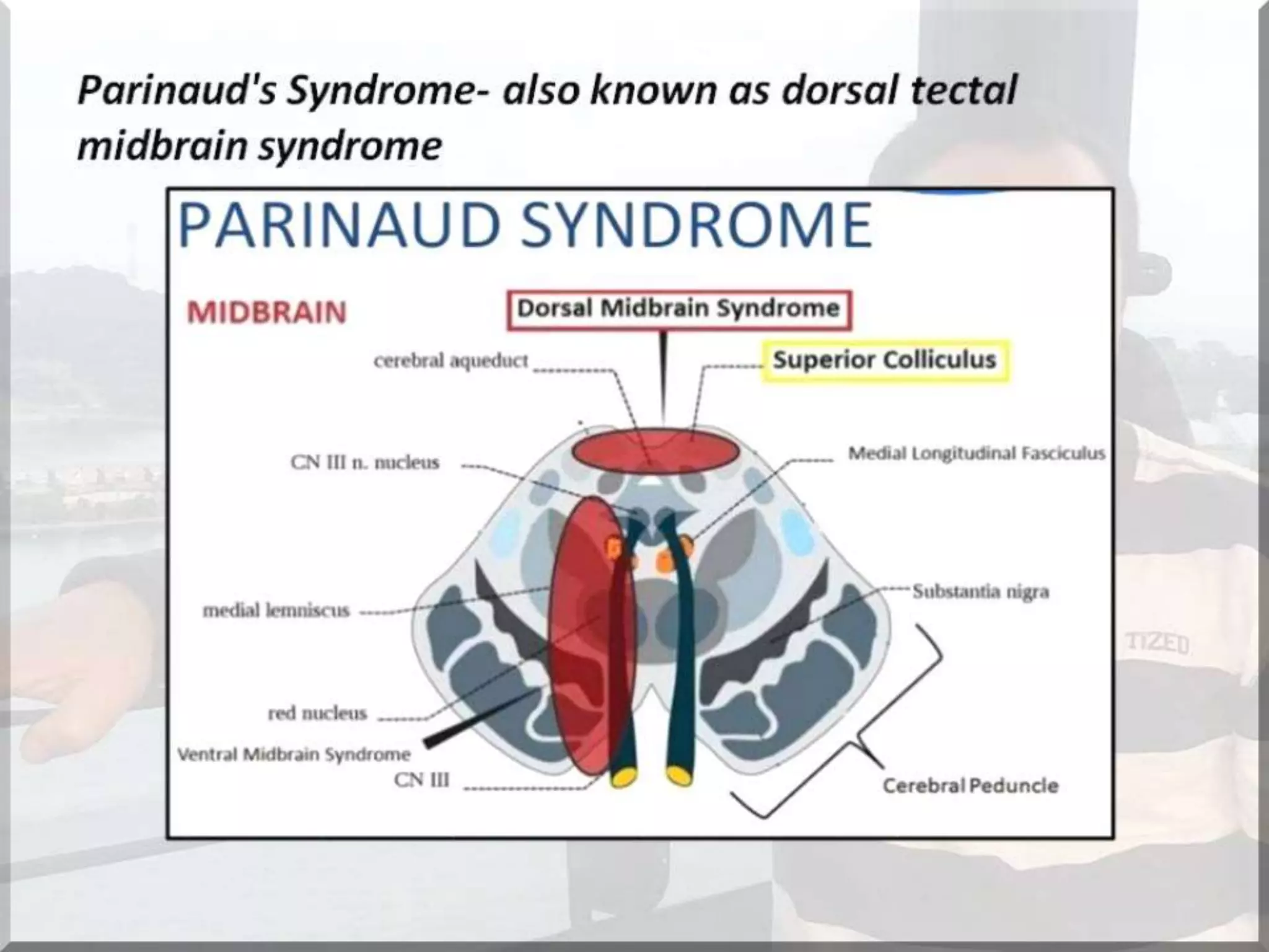 Localization of brainstem lesion by Prof Dr Bashir Ahmed Dar Sopore Kashmir
