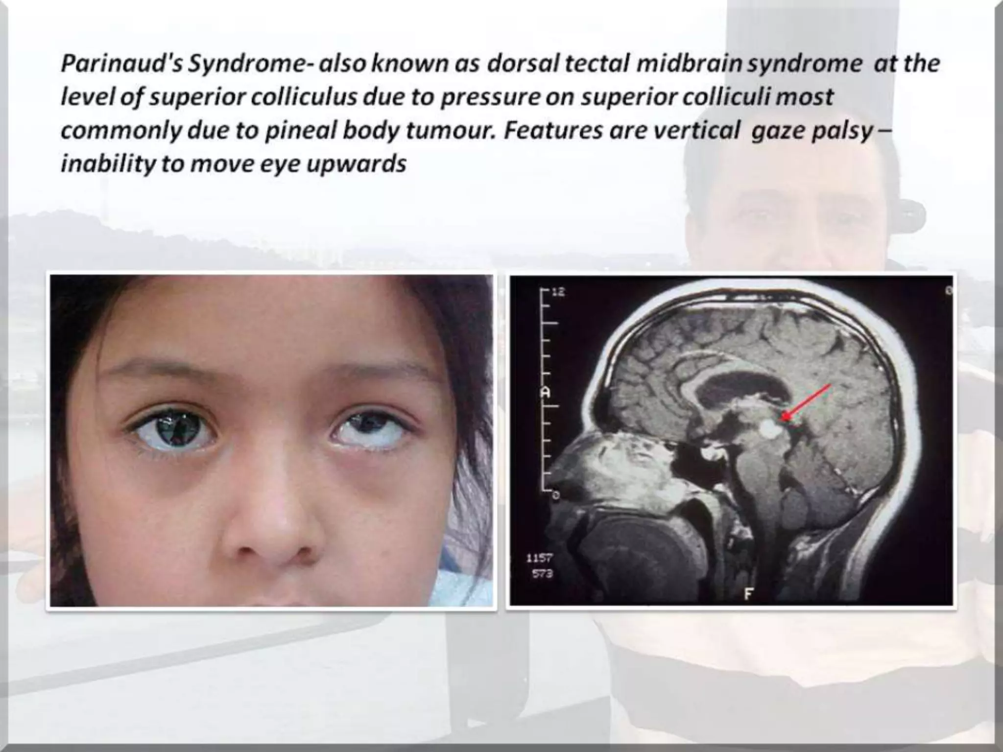 Localization of brainstem lesion by Prof Dr Bashir Ahmed Dar Sopore Kashmir