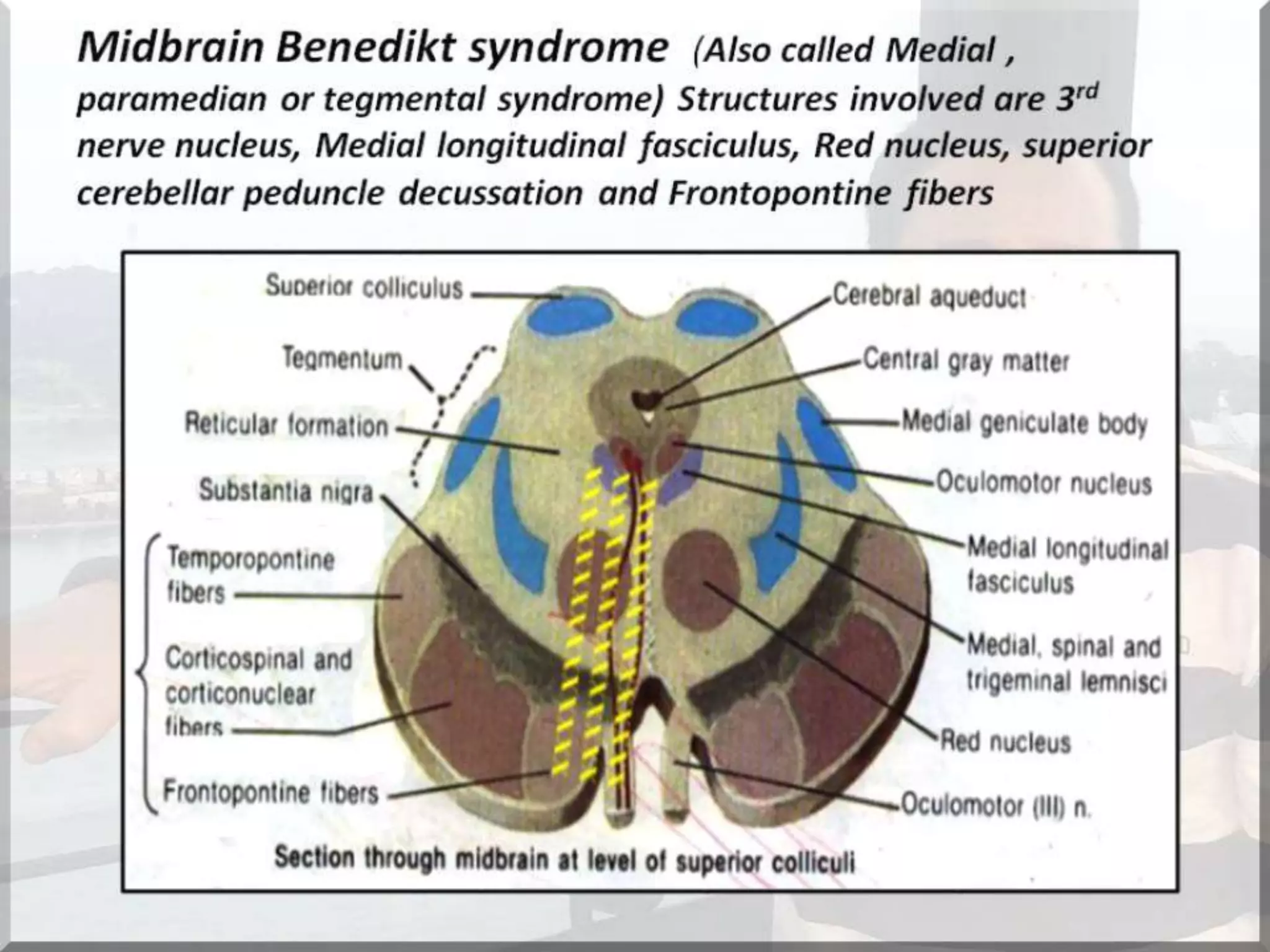 Localization of brainstem lesion by Prof Dr Bashir Ahmed Dar Sopore Kashmir