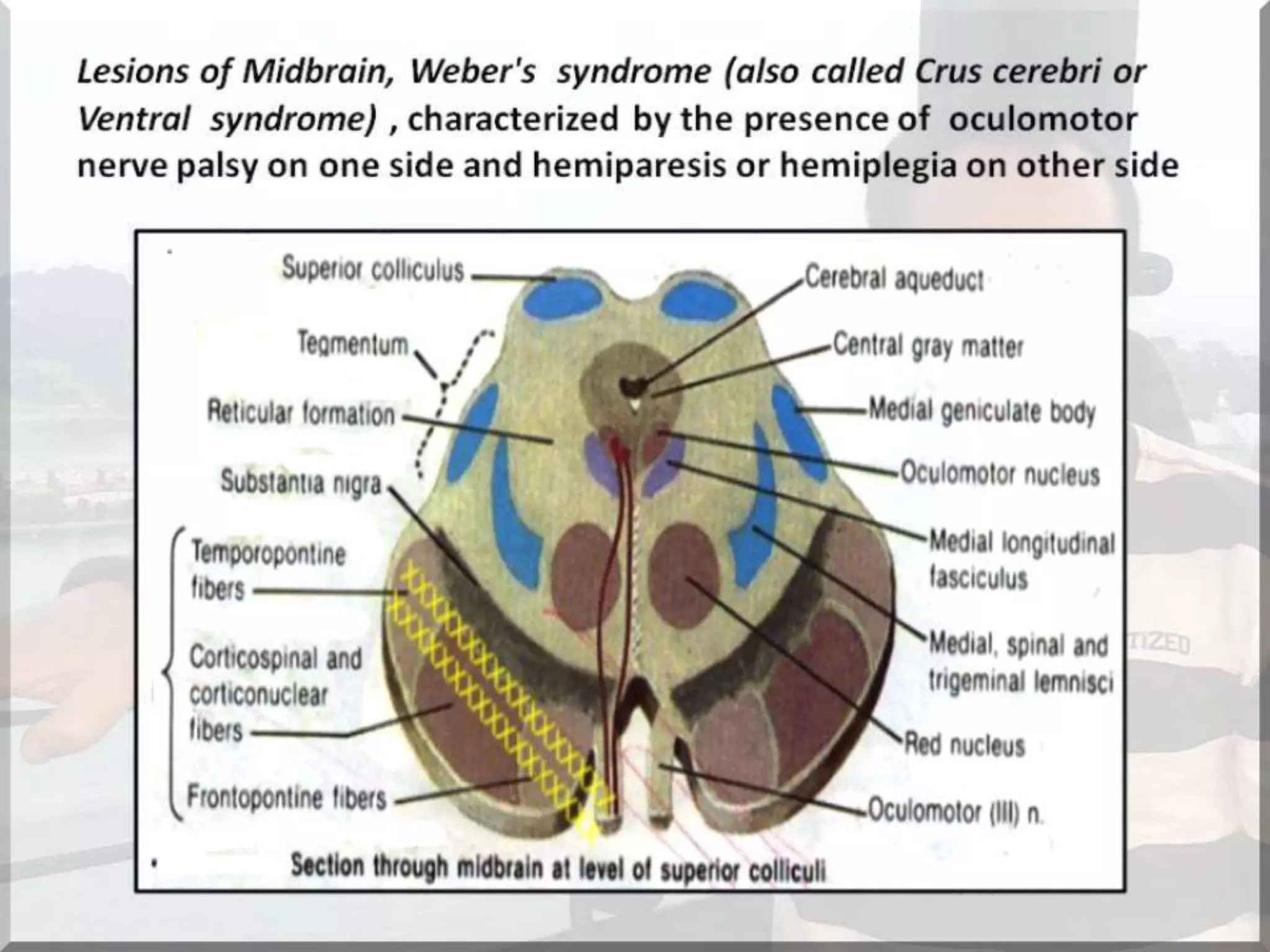 Localization of brainstem lesion by Prof Dr Bashir Ahmed Dar Sopore Kashmir