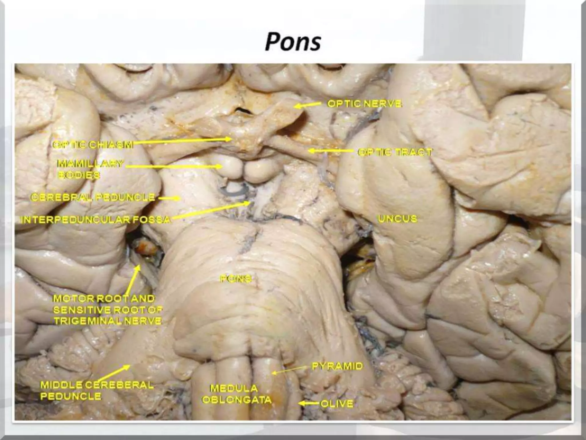 Localization of brainstem lesion by Prof Dr Bashir Ahmed Dar Sopore Kashmir