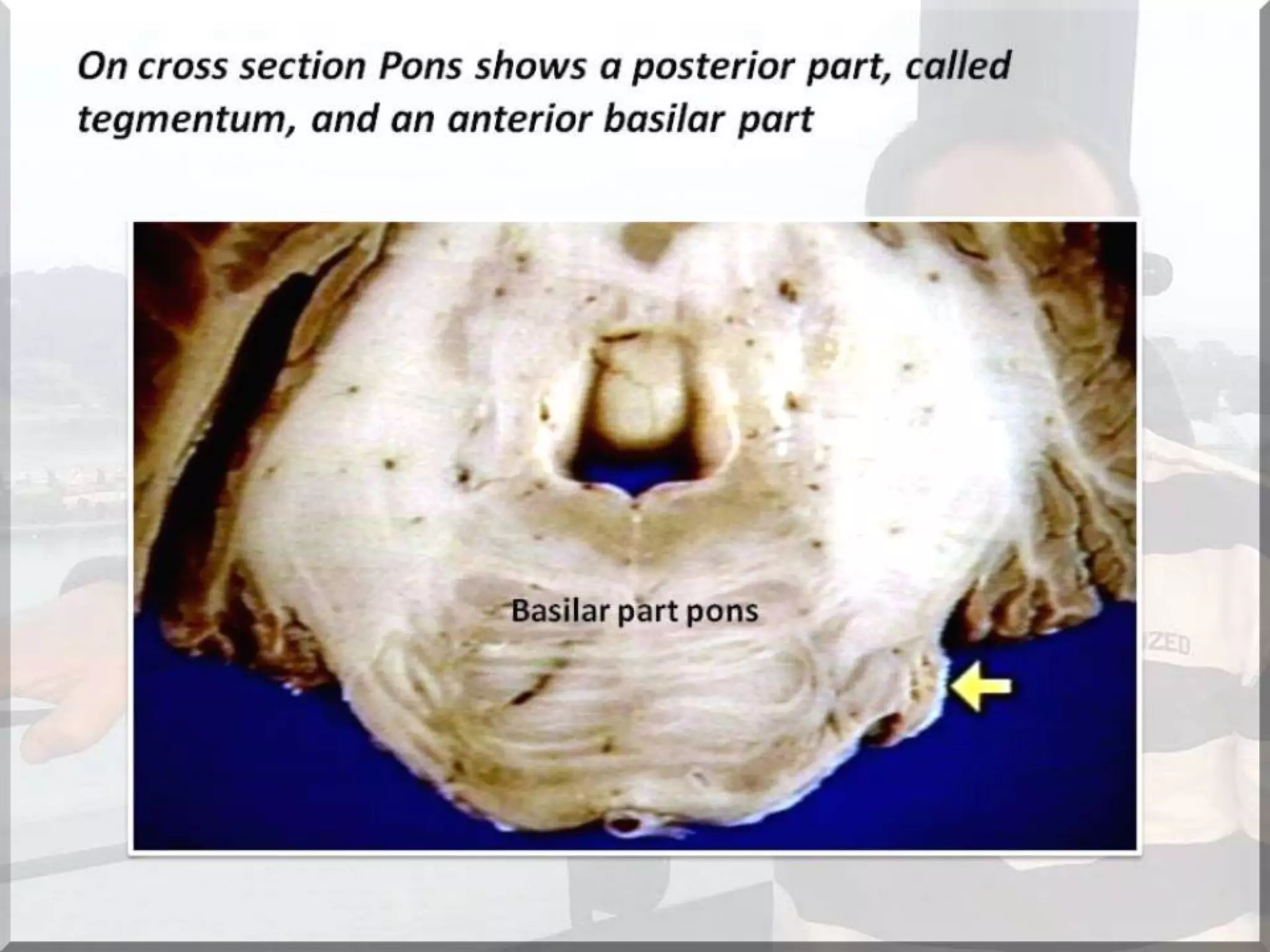 Localization of brainstem lesion by Prof Dr Bashir Ahmed Dar Sopore Kashmir