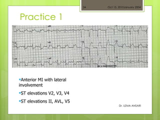 Practice 1 Dr. UZMA ANSARI <ul><li>Anterior MI with lateral involvement </li></ul><ul><li>ST elevations V2, V3, V4  </li><...