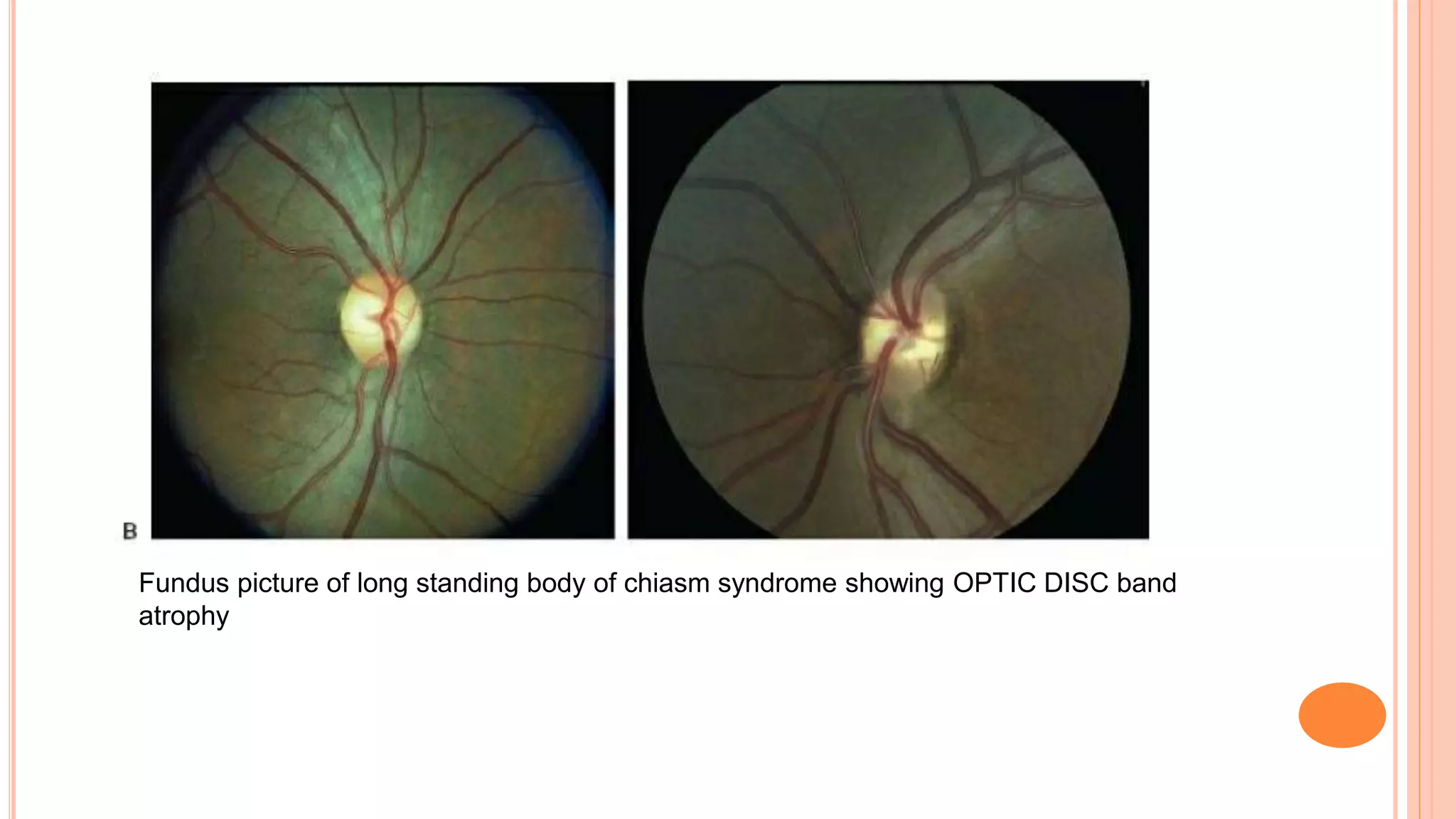 Localizing Signs For Lesion Of Visual Pathway Ppt Localizing Signs For Lesion Of Visual Pathway Ppt