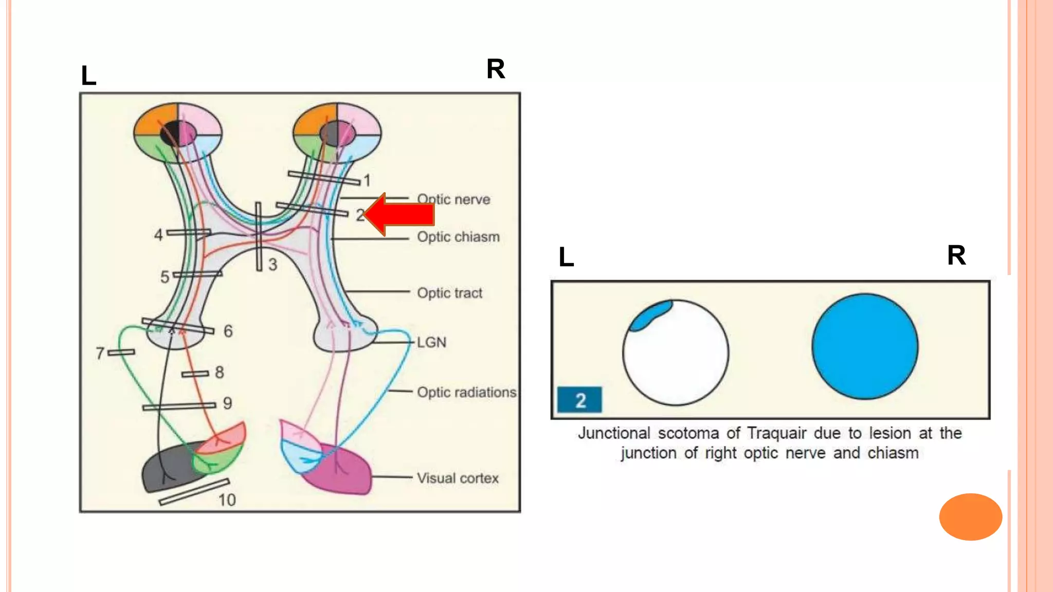Localizing Signs For Lesion Of Visual Pathway Ppt Localizing Signs For Lesion Of Visual Pathway Ppt