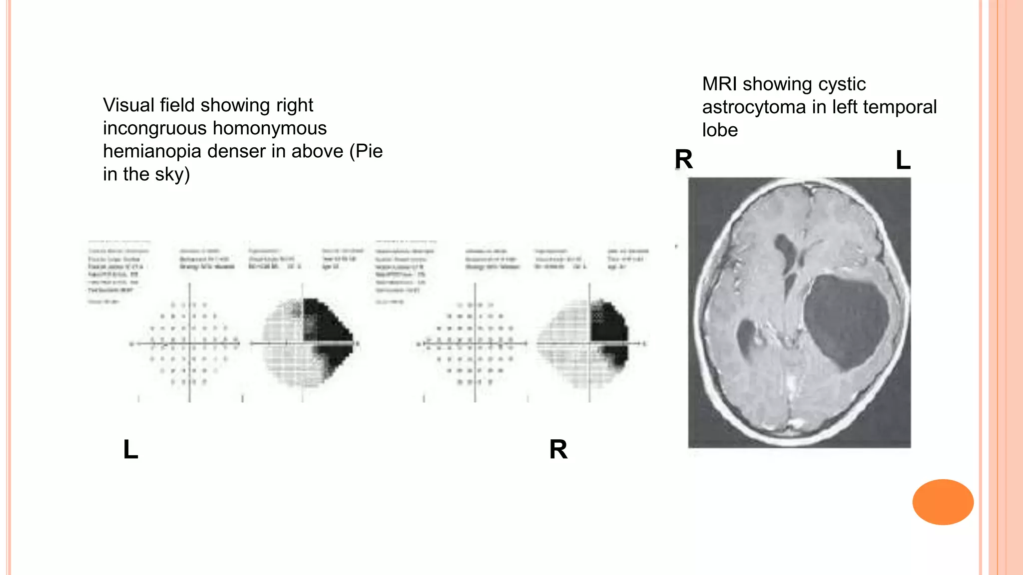 Localizing Signs For Lesion Of Visual Pathway Ppt Localizing Signs For Lesion Of Visual Pathway Ppt