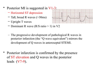 Localizing Mi Comprehensive ECG Interpretation for Localizing Myocardial Infarcts | PPTX