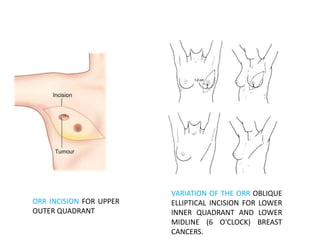 Orr Incision Locally advanced breast cancer | PPTX