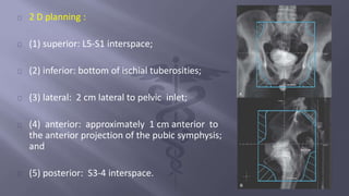 2 D planning : 
(1) superior: L5-S1 interspace; 
(2) inferior: bottom of ischial tuberosities; 
(3) lateral: 2 cm lateral to pelvic inlet; 
(4) anterior: approximately 1 cm anterior to 
the anterior projection of the pubic symphysis; 
and 
(5) posterior: S3-4 interspace. 
 