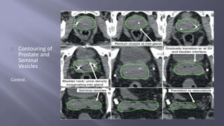 Contouring of 
Prostate and 
Seminal 
Vesicles 
Contnd.. 
 