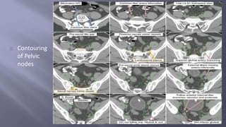 Contouring 
of Pelvic 
nodes 
 