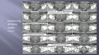 Contouring 
of Pelvic 
nodes 
Contind… 
 