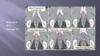 Adjuvant 
RT / 
Salvage RT 
 