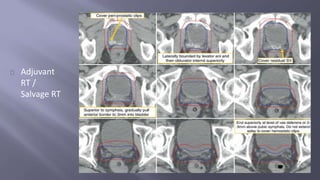 Adjuvant 
RT / 
Salvage RT 
 