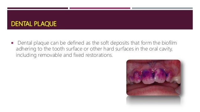 local predisposing factor of periodontal disease how does plaque form