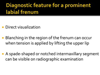  Direct visualization
 Blanching in the region of the frenum can occur
when tension is applied by lifting the upper lip
 A spade-shaped or notched intermaxillary segment
can be visible on radiographic examination
 