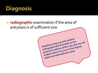  radiographic examination if the area of
ankylosis is of sufficient size
 