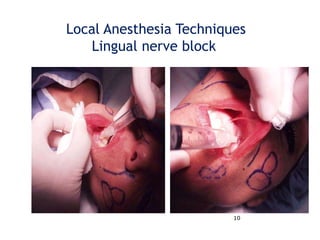 10
Local Anesthesia Techniques
Lingual nerve block
 