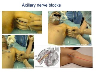 12
Axillary nerve blocks
 