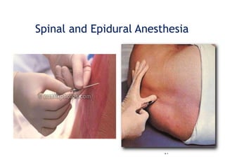 17
Spinal and Epidural Anesthesia
 
