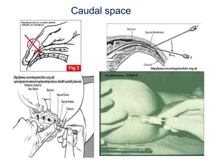 21
Caudal space
 