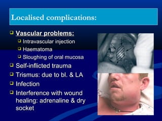 Localised complications:


Vascular problems:









Intravascular injection
Haematoma
Sloughing of oral mucosa

Self-inflicted trauma
Trismus: due to bl. & LA
Infection
Interference with wound
healing: adrenaline & dry
socket

 