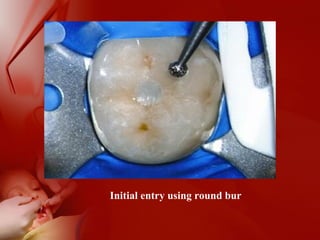 Initial entry using round bur
 
