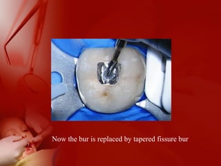 Now the bur is replaced by tapered fissure bur
 