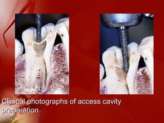 Clinical photographs of access cavityClinical photographs of access cavity
preparationpreparation
 