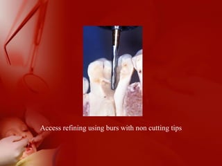 Access refining using burs with non cutting tips
 