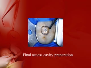 Final access cavity preparation
 