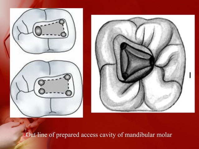 Locating root canal orifice in molar RCT PPT