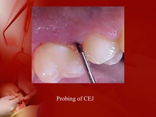 Probing of CEJ
 